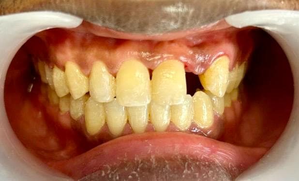 Fin du traitement orthodontique, avant la reconstruction